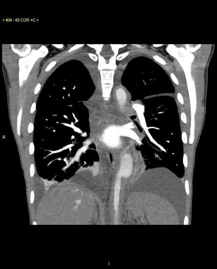 CT Angiography of the chest demonstrates aneurysmal descending thoracic aorta 